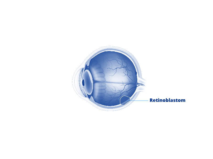 Illustration eines Retinoblastoms.